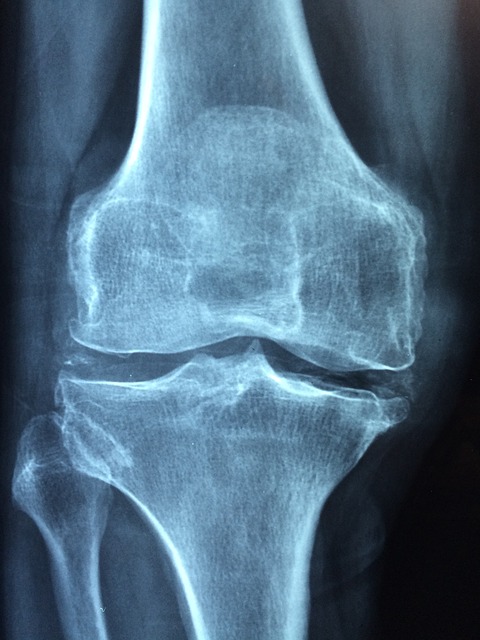 osteoarthritis in the knee