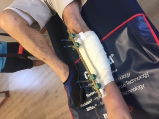 External fixator on trauma patient